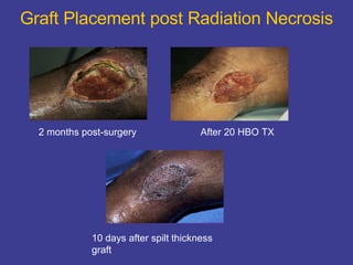 Graft Placement post Radiation Necrosis 2 months post-surgery After 20 HBO TX 10 days after spilt thickness graft 