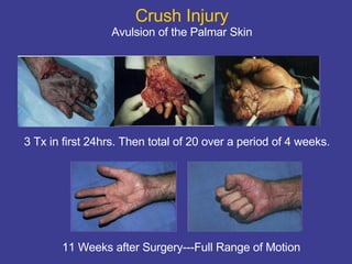 Crush Injury Avulsion of the Palmar Skin decreased perfusion or hypoxia » HBO at 11 Weeks after Surgery---Full Range of Motion 3 Tx in first 24hrs. Then total of 20 over a period of 4 weeks. 