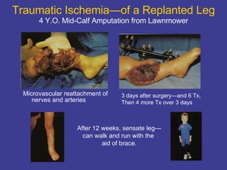 Traumatic Ischemia—of a Replanted Leg 4 Y.O. Mid-Calf Amputation from Lawnmower Microvascular reattachment of nerves and arteries 3 days after surgery—and 6 Tx, Then 4 more Tx over 3 days After 12 weeks, sensate leg--- can walk and run with the  aid of brace. 