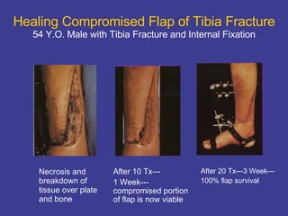 Healing Compromised Flap of Tibia Fracture 54 Y.O. Male with Tibia Fracture and Internal Fixation Necrosis and  breakdown of tissue over plate and bone After 10 Tx--- 1 Week---compromised portion of flap is now viable After 20 Tx---3 Week— 100% flap survival 