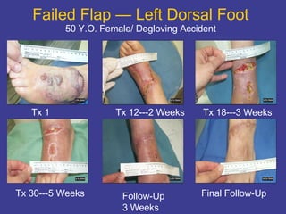 Failed Flap — Left Dorsal Foot 50 Y.O. Female/ Degloving Accident Tx 1 Tx 30---5 Weeks Tx 18---3 Weeks Tx 12---2 Weeks Follow-Up 3 Weeks Final Follow-Up 