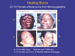 Healing Burns   23 YO Female w/facial burns from flaming gasoline  A C B D A-12 hrs after injury  B-24 hrs and 2 HBO tx’s C-72 hrs later and 6 tx’s   D-Shortly before discharge 