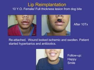 Lip Reimplantation 10 Y.O. Female/ Full thickness lesion from dog bite Re-attached.  Wound looked ischemic and swollen. Patient started hyperbarics and antibiotics.  After 10Tx Follow-up: Happy Smile 