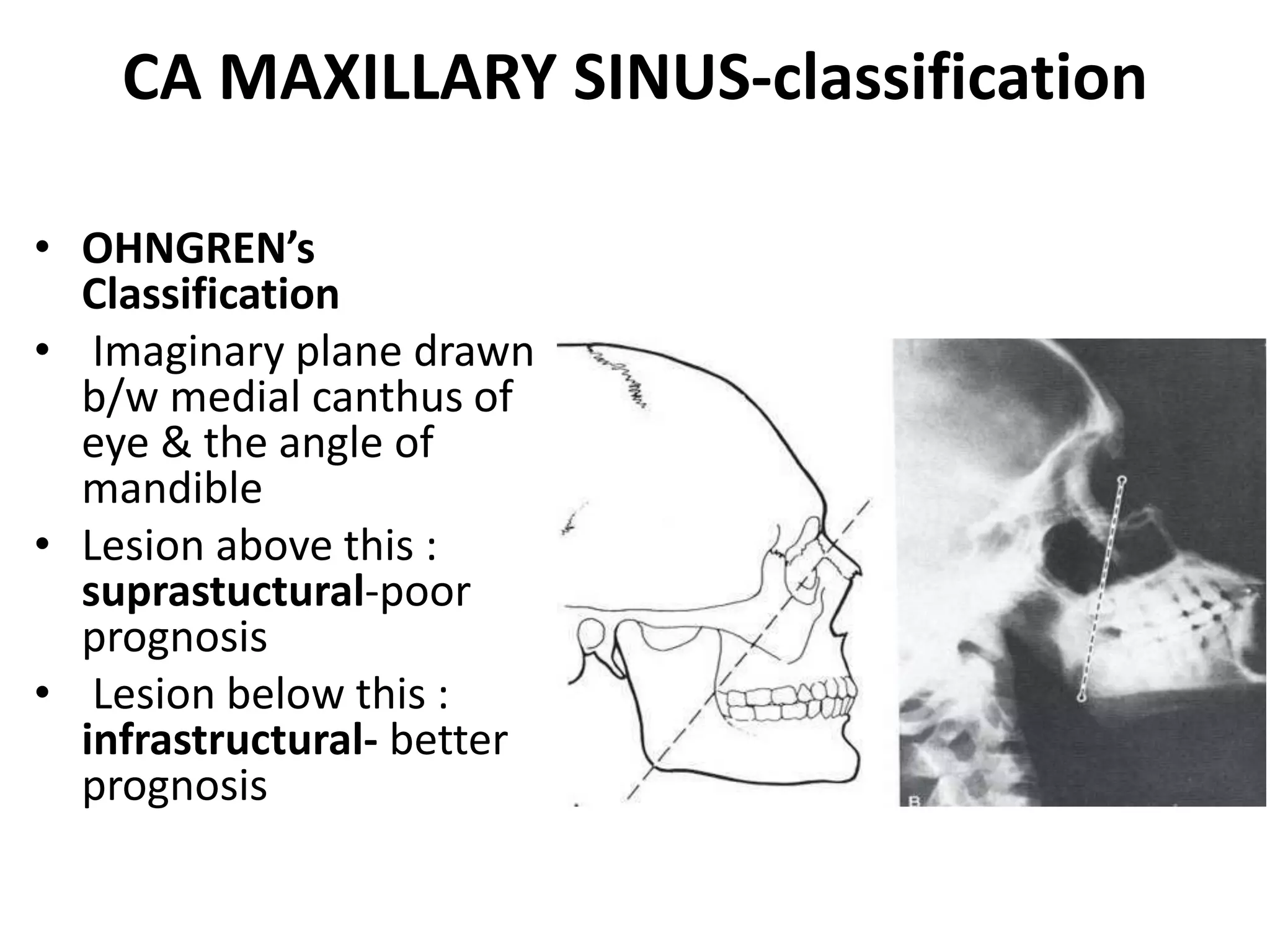 Nose and PNS Carcinoma (for UNDERGRADUATES) | PPTX