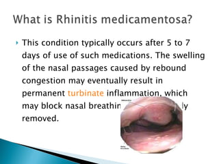 This condition typically occurs after 5 to 7 days of use of such medications. The swelling of the nasal passages caused by rebound congestion may eventually result in permanent  turbinate  inflammation, which may block nasal breathing until surgically removed. 