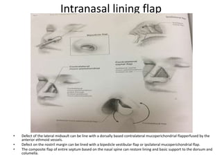 Intranasal lining flap
• Defect of the lateral midvault can be line with a dorsally based contralateral mucoperichondrial flapperfused by the
anterior ethmoid vessels.
• Defect on the nostril margin can be lined with a bipedicle vestibular flap or ipsilateral mucoperichondrial flap.
• The composite flap of entire septum based on the nasal spine can restore lining and basic support to the dorsum and
columella.
 