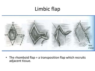 Limbic flap
• The rhomboid flap = a transposition flap which recruits
adjacent tissue.
 