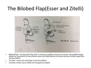 The Bilobed Flap(Esser and Zitelli)
• Bilobed flap = transposition flap with 2 cutaneous paddles and common base. Two paddle design
allows for movement of recruitment areas and redistribution of closure tension further away from
primary defect.
• 1st lobe = same size and shape as primary defect;
• 2nd lobe smaller (up to 50%) and triangularly-shaped.
 