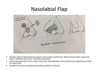Nasolabial Flap
 Random pattern flaps based on angular / facial artery perforators. May be based either superiorly
(alar or sidewall subunits) or inferiorly (columella).
 Utilize abundant skin of the medial cheek and nasolabial fold, which tends to be a good tissue match
for nasal cover.
 Suitable for reconstructing partial thickness defects of the ala.
 