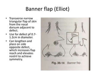 Banner flap (Elliot)
• Transverse narrow
triangular flap of skin
from the nasal
dorsum adjacent to
defect.
• Use for defect pf 0.7-
1.2cm in diameter.
• Can lengthen and
place on side
opposite defect,
which increases flap
reach and elevates
nostril to achieve
symmetry.
 