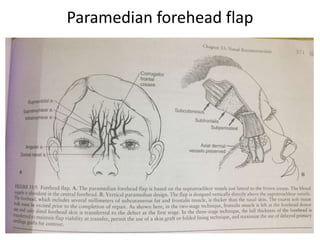 Paramedian forehead flap
 