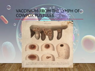 VACCINIUM-FROM THE LYMPH OF
COWPOX PUSTULES
 