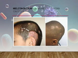 MELITAGRINUM- NOSODE OF ECZEMA
CAPITIS
 