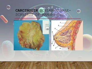 CARCINOSIN SCHIRR-MAMMAE-
SCHHIRUS OF MAMMAE.
 