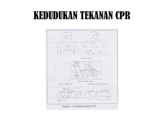 KEDUDUKAN TEKANAN CPR
 