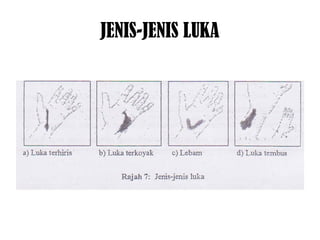 JENIS-JENIS LUKA
 
