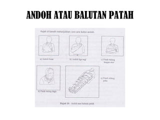 ANDOH ATAU BALUTAN PATAH
 