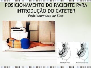 POSICIONAMENTO DO PACIENTE PARA
INTRODUÇÃO DO CATETER
Posicionamento de Sims
 