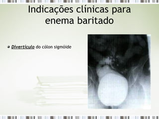 Divertículo do cólon sigmóide
Indicações clínicas para
enema baritado
 