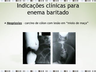 Neoplasias – carcino de cólon com lesão em “miolo de maça”
Indicações clínicas para
enema baritado
 