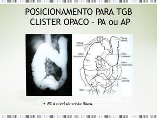 POSICIONAMENTO PARA TGB
CLISTER OPACO – PA ou AP
RC à nível da crista ilíaca;
 