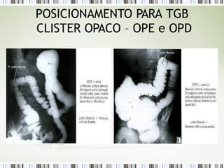 POSICIONAMENTO PARA TGB
CLISTER OPACO – OPE e OPD
 