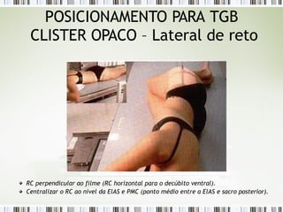 POSICIONAMENTO PARA TGB
CLISTER OPACO – Lateral de reto
RC perpendicular ao filme (RC horizontal para o decúbito ventral).
Centralizar o RC ao nível da ElAS e PMC (ponto médio entre a ElAS e sacro posterior).
 