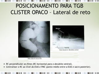POSICIONAMENTO PARA TGB
CLISTER OPACO – Lateral de reto
RC perpendicular ao filme (RC horizontal para o decúbito ventral).
Centralizar o RC ao nível da ElAS e PMC (ponto médio entre a ElAS e sacro posterior).
 