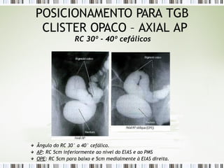 POSICIONAMENTO PARA TGB
CLISTER OPACO – AXIAL AP
RC 30º - 40º cefálicos
Ângulo do RC 30° a 40° cefálico.
AP: RC 5cm inferiormente ao nível do ElAS e ao PMS
OPE: RC 5cm para baixo e 5cm medialmente à ElAS direita.
 