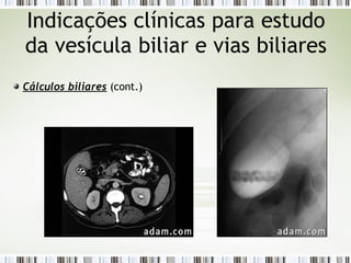 Cálculos biliares (cont.)
Indicações clínicas para estudo
da vesícula biliar e vias biliares
 