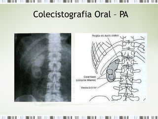Colecistografia Oral – PA
 