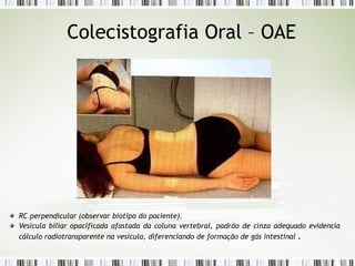 Colecistografia Oral – OAE
RC perpendicular (observar biotipo do paciente).
Vesícula biliar opacificada afastada da coluna vertebral, padrão de cinza adequado evidencia
cálculo radiotransparente na vesícula, diferenciando de formação de gás intestinal .
 