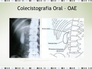 Colecistografia Oral – OAE
 