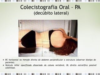 Colecistografia Oral – PA
(decúbito lateral)
RC horizontal na metade direita do abdome perpendicular a estrutura (observar biotipo do
paciente).
Vesícula biliar opacificada dissociada da coluna vertebral, DL direito estratifica possível
colelitíase.
 