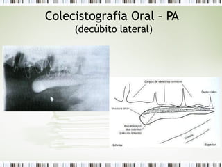 Colecistografia Oral – PA
(decúbito lateral)
 