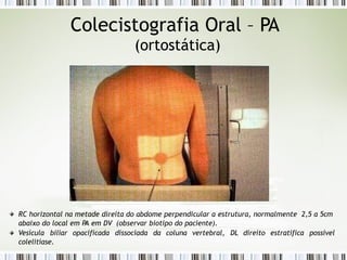 Colecistografia Oral – PA
(ortostática)
RC horizontal na metade direita do abdome perpendicular a estrutura, normalmente 2,5 a 5cm
abaixo do local em PA em DV (observar biotipo do paciente).
Vesícula biliar opacificada dissociada da coluna vertebral, DL direito estratifica possível
colelitíase.
 
