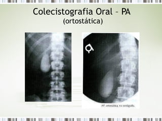 Colecistografia Oral – PA
(ortostática)
 