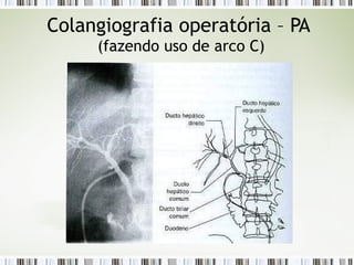 Colangiografia operatória – PA
(fazendo uso de arco C)
 