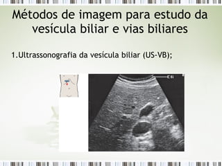 1.Ultrassonografia da vesícula biliar (US-VB);
Métodos de imagem para estudo da
vesícula biliar e vias biliares
 