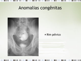 Anomalias congênitas
Rim pélvico
 