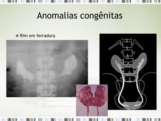 Anomalias congênitas
Rim em ferradura
 