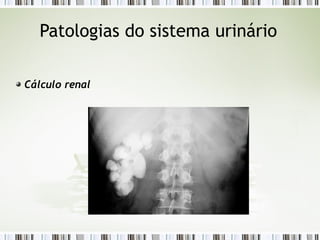 Patologias do sistema urinário
Cálculo renal
 