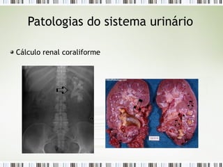 Patologias do sistema urinário
Cálculo renal coraliforme
 