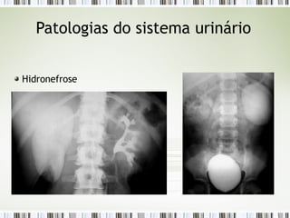 Patologias do sistema urinário
Hidronefrose
 