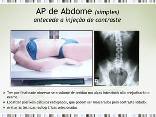 AP de Abdome (simples)
antecede a injeção de contraste
Tem por finalidade observar se o volume de resíduo nas alças intestinais não prejudicarão o
exame.
Localizar possíveis cálculos radiopacos, que podem ser mascarados pelo contraste iodado.
Avaliar as técnicas radiográficas selecionadas
 