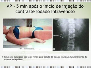 AP - 5 min após o início de injeção do
contraste iodado intravenoso
Incidência localizada das lojas renais para estudo do estágio inicial do funcionamento do
sistema nefrográfico.
 