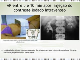 AP entre 5 e 10 min após injeção do
contraste iodado intravenoso
Incidência localizada, com compressão, das lojas renais para estudo do estágio de filtração
e eliminação pelo sistema pielocalicial.
 