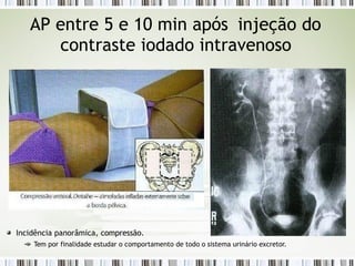 AP entre 5 e 10 min após injeção do
contraste iodado intravenoso
Incidência panorâmica, compressão.
Tem por finalidade estudar o comportamento de todo o sistema urinário excretor.
 