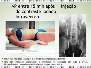 AP entre 15 min após injeção
do contraste iodado
intravenoso
por todo o ureter,
Incidência realizada logo após a retirada da compressão abdominal.
Tem por finalidade acompanhar a eliminação do contraste
bilateralmente, devendo ser realizada uma imagem panorâmica.
 