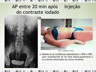 AP entre 20 min após injeção
do contraste iodado
intravenoso
Realiza-se as incidências panorâmicas e OPD e OPE,
para visualizarmos os rim mais antero-posteriores e
os ureteres dissociados da coluna vertebral.
 